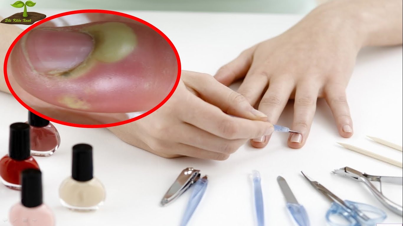 Một Số Bệnh Nhiễm Trùng Có Thể Mắc Phải Khi Đi Làm Nails